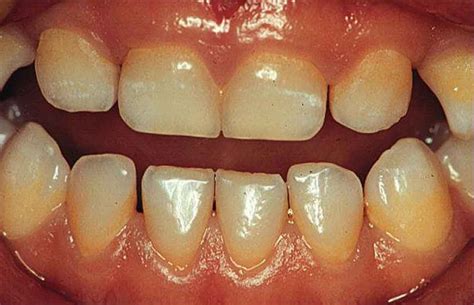 Enamel Hypoplasia