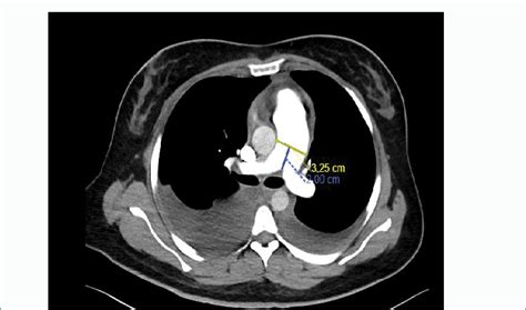 Computed tomography pulmonary angiogram showing an enlarged pulmonary... | Download Scientific ...