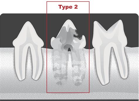 Types of Resorption Based on Radiographic Appearance - Veterinary ...