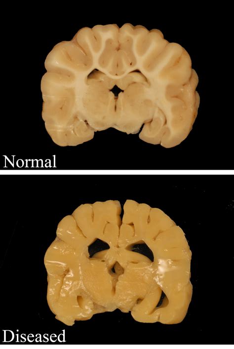 Rare neurological disease shines light on health of essential nerve cells