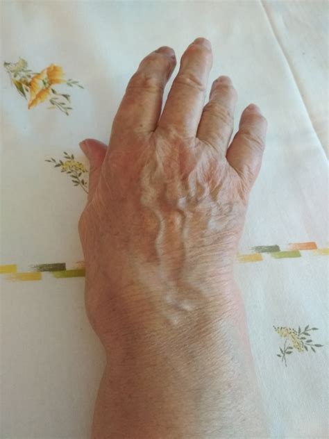 Symptoms of wrist arthritis | General center | SteadyHealth.com