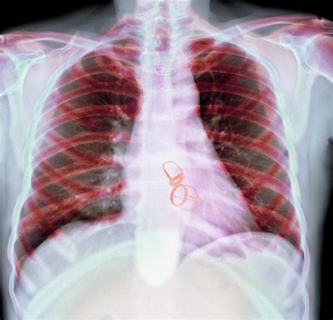 Prosthetic Heart Valves Photograph by Science Photo Library - Pixels