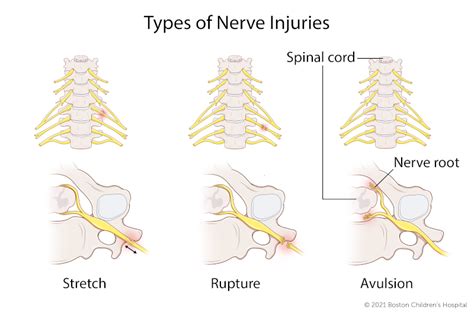 Brachial Plexus Birth Injury | Boston Children's Hospital