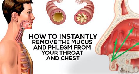 How to Get Rid of Phlegm and Mucus in Chest & Throat - Hecspot | Mucus, Getting rid of phlegm ...