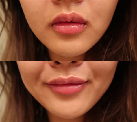 My Lip Fillers Experience - By Lifestyle Blogger Demi Bang - Affiliated Dermatology