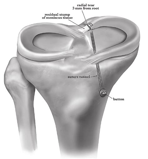 Posterior Horn Medial Meniscus Anatomy | Images and Photos finder