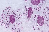 Leishmania donovani, causes Kala-Azar, smear from the infected spleen showing the typical ...