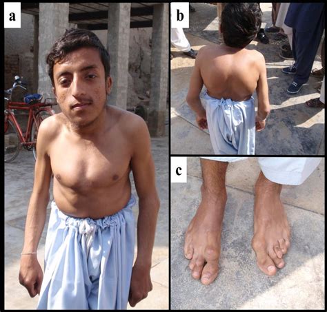 4: a: Kyphosis (pectus excavatum), b: kyphosis, c: contracted toe or... | Download Scientific ...