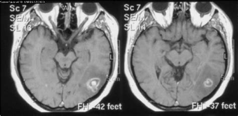 Cerebral toxoplasmosis. MRI (T1-w with contrast medium) transversal... | Download Scientific Diagram