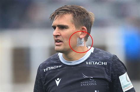 Why do Newcastle Falcons wear plasters behind their ears? How the stickers are fighting head ...