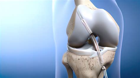 The Life-Changing Benefits of ACL Reconstruction Surgery - Blog News ...