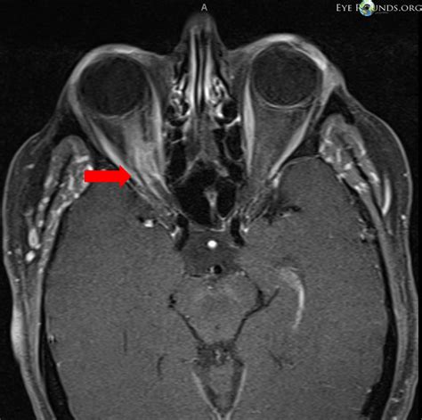 Atlas Entry - Optic nerve sheath meningioma