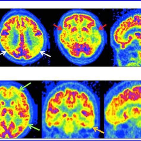 (A) Typical features of a positive amyloid PET scan -"tree-in-bloom"... | Download Scientific ...