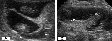 Ultrasound-Detected Subchorionic Hemorrhage and the Obstetri ...