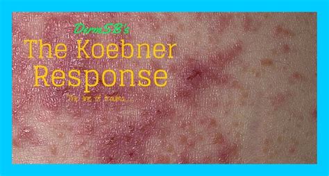 The Koebner Phenomenon - Dermatologists Sans Borders