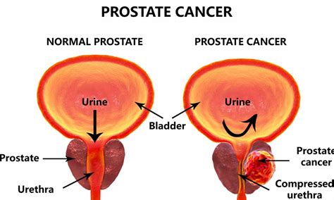 Prostate function, structure, lobes, Benign enlargement of prostate and malignant prostatic ...