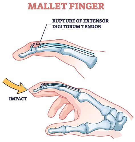 What Is Mallet Finger and How Do I Know if I Have It?