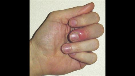 How I Cured My Fingernail Fungus Infection on Two Different Occasions ...