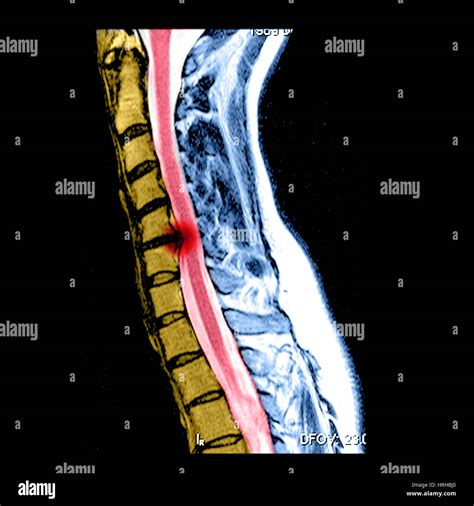 Mri Of A Cervical Herniated Disc High Resolution Stock Photography And ...