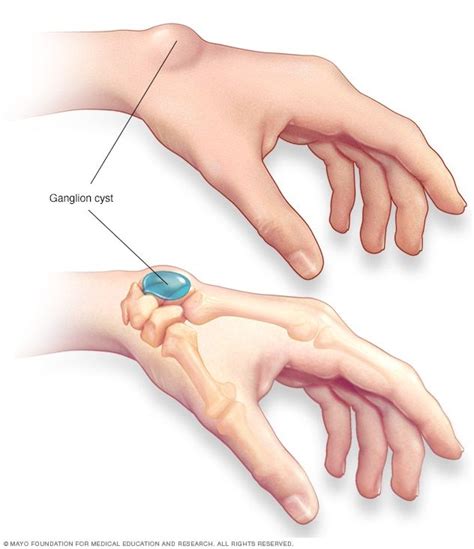 Ganglion cyst - Symptoms and causes - Mayo Clinic Ganglion Cyst Removal, Ganglion Cyst Wrist ...