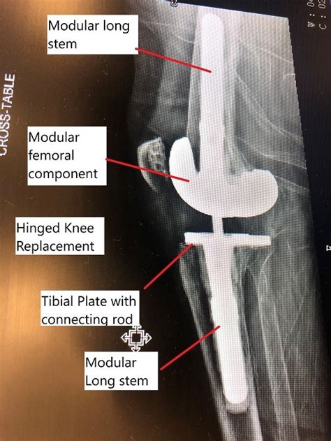 Buckling after Total Knee Replacement - Complete Orthopedics