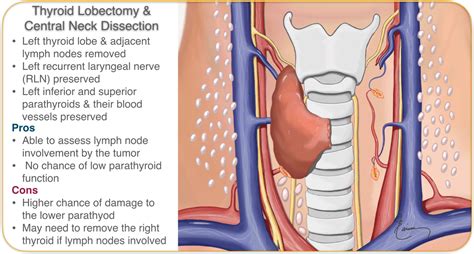 Minimally Invasive Parathyroidectomy