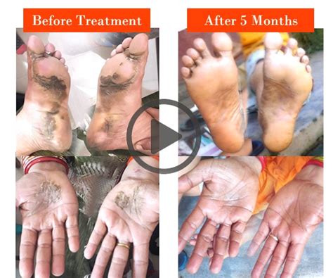 Palmar Psoriasis Treatment a Journey to Success -Astang Ayurveda