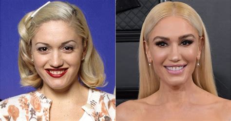 Has Gwen Stefani Had Plastic Surgery? See What Experts Think