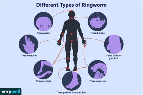 Wat is ringworm? - Med NL