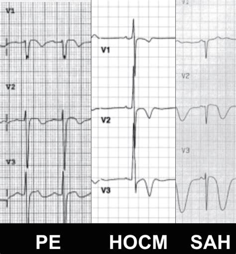 R.E.B.E.L. ECG of the Week: Wellens' Syndrome or STEMI - R.E.B.E.L. EM ...