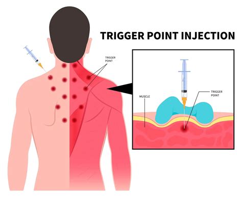 Trigger Point Injection - Purpose, Procedure, Technique