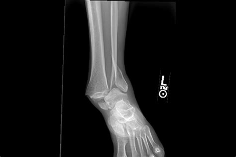 Ortho Dx: How would you treat this ankle fracture dislocation ...