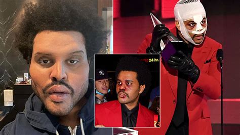 What Happened To The Weeknd’s Face? His Bandages, Botox & Plastic Surgery Photos... - Capital