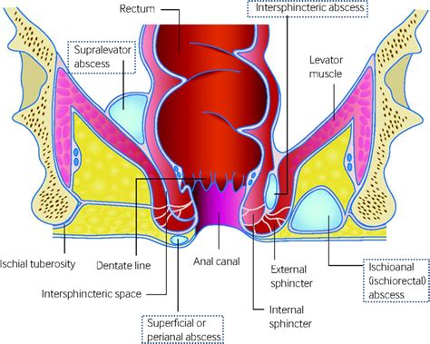 Paraproctitis and Anorectal Abscess – Drs Diary