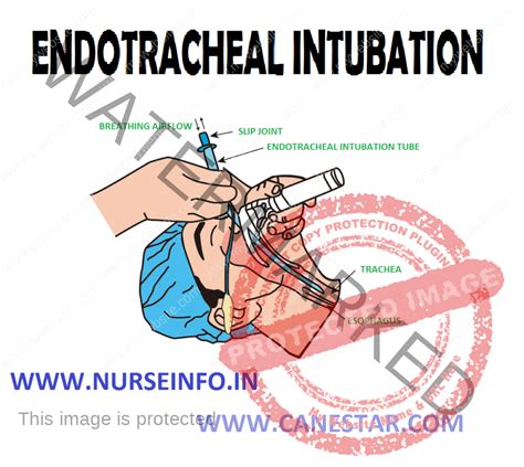 Endotracheal Intubation Equipment