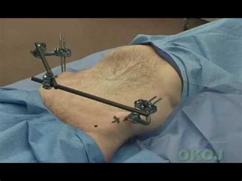 Application of a Pelvic External Fixator Surgical Technique - YouTube