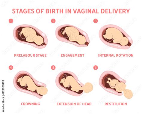 Vetor de Stages of baby birth in vaginal delivery do Stock | Adobe Stock