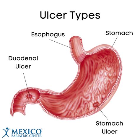 Signs and Symptoms of Ulcers After Gastric Bypass - Mexico Bariatric Center