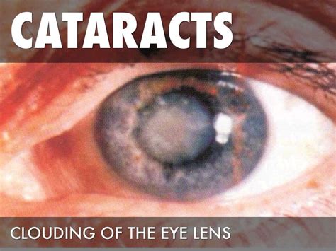 Cataract: 10 Cataract Symptoms