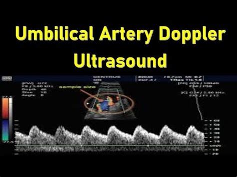 Umbilical Artery Doppler Ultrasound Interpretation / Doppler Ultrasound in Fetal Growth ...