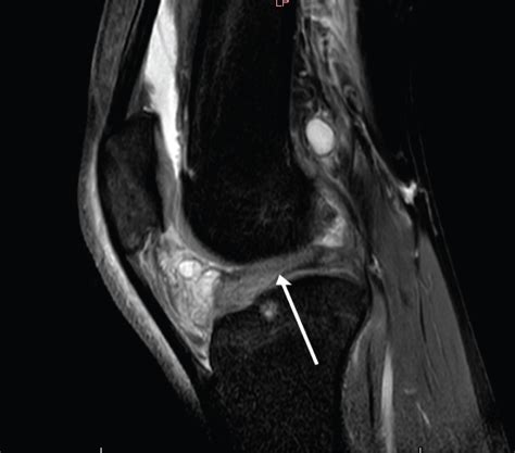 Localized Anterior Arthrofibrosis of the Knee that Occurs after Meniscal Surgery