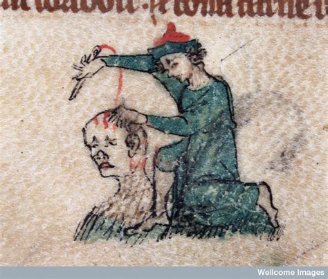 Terrifying medieval medical procedures that will make your toes curl