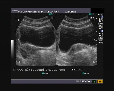 cochinblogs: Twinkle (color Doppler) artifacts in urinary calculi