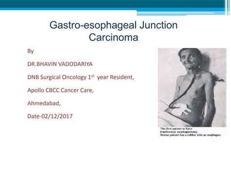 Gastroesophageal Junction Carcinoma | PPT