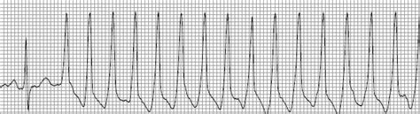 PSVT / PAT / SVT - equimedcorp