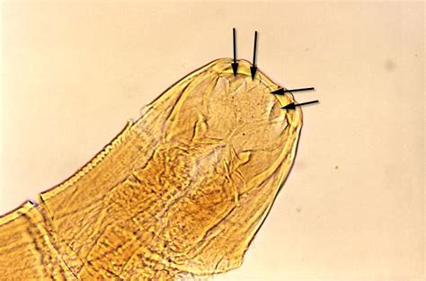 Ancylostomiasis laboratory findings - wikidoc