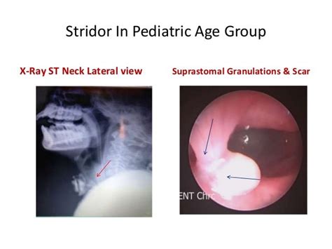 Stridor in pediatric age group