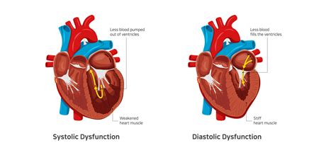 Systolic Vs Diastolic Heart Failure Symptoms | My XXX Hot Girl