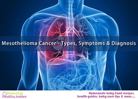 Mesothelioma Cancer - Types, Symptoms & Diagnosis