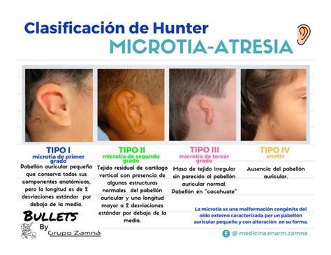 Microtia y Atresia | uDocz